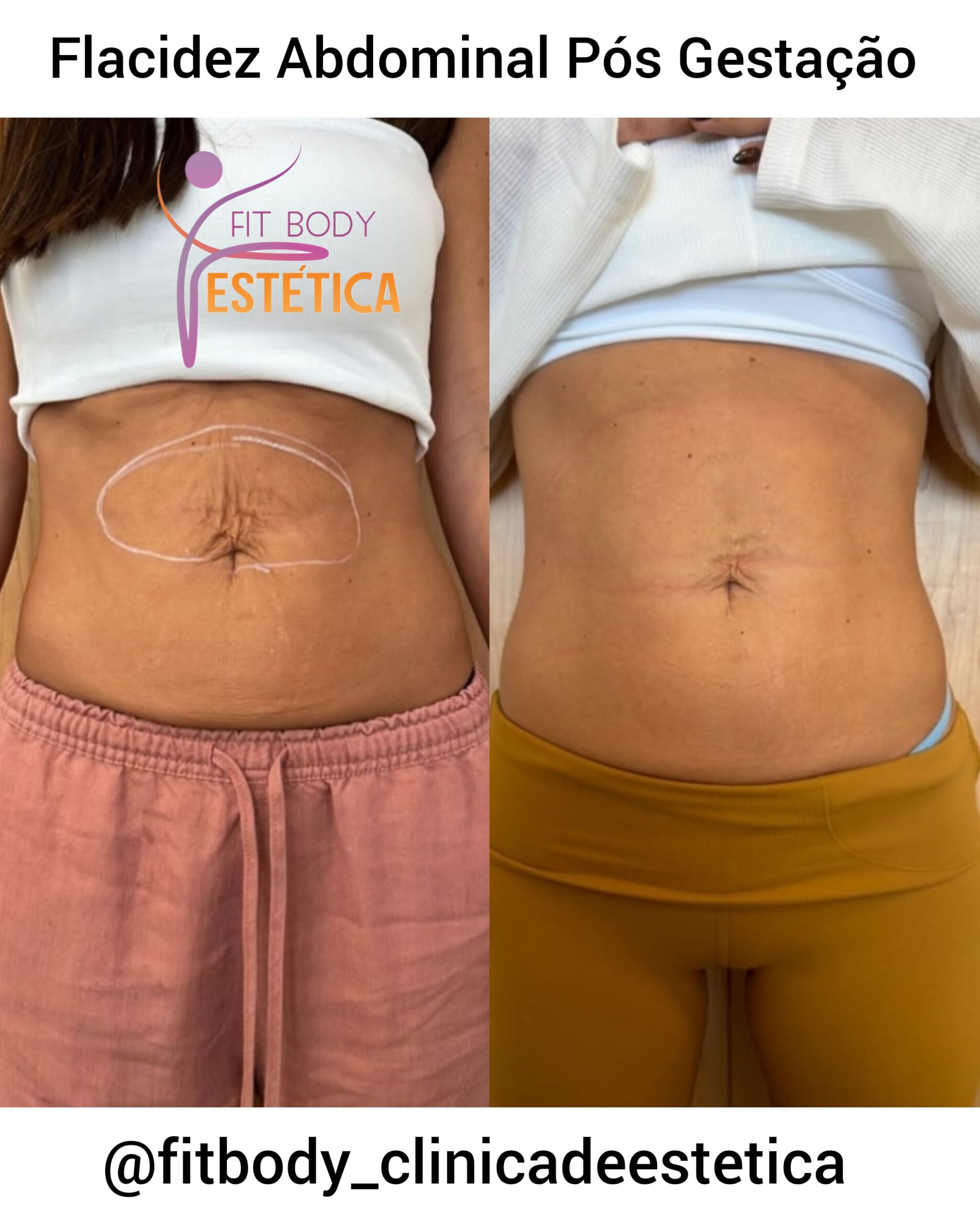 Flacidez Abdominal Pós Gestação