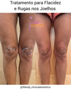 Flacidez e Rugas nos Joelhos