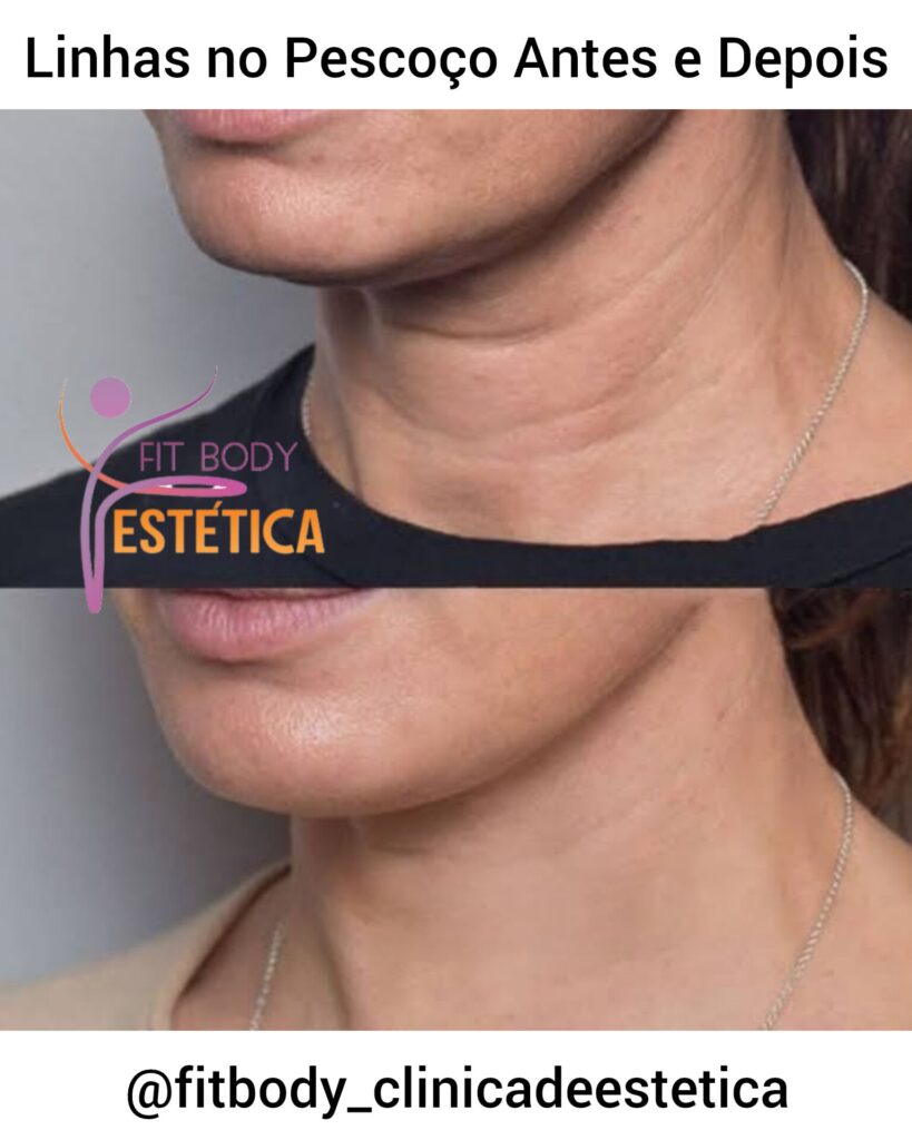 Linhas no Pescoço Antes e Depois