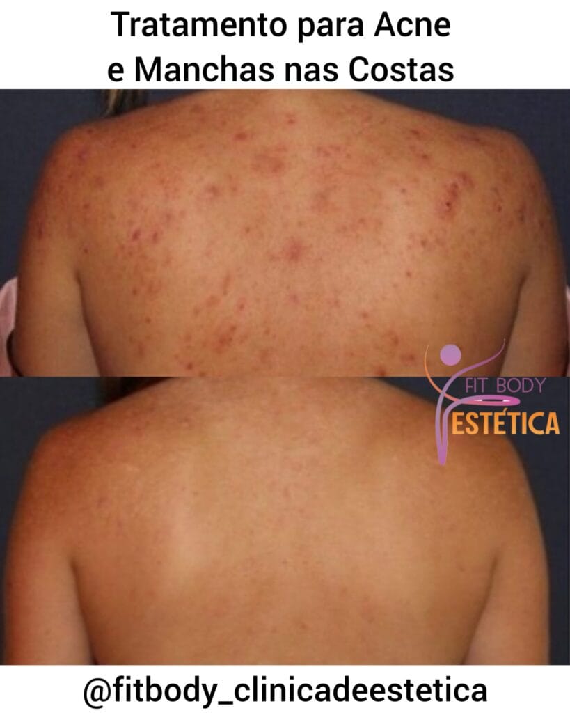 Manchas de Acne nas Costas Antes e Depois