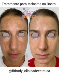 Melasma no Rosto