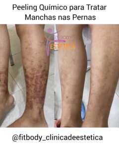Peeling Químico para Tratar Manchas nas Pernas