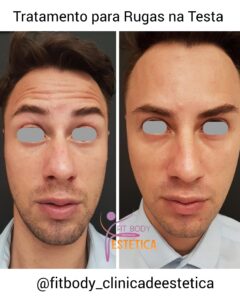 Rugas na Testa Antes e Depois