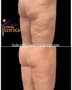 Subcisão Antes e Depois