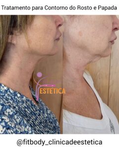 Tratamento para Contorno do Rosto e Papada