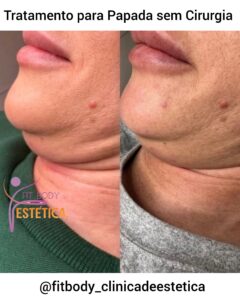 Tratamento para Papada sem Cirurgia